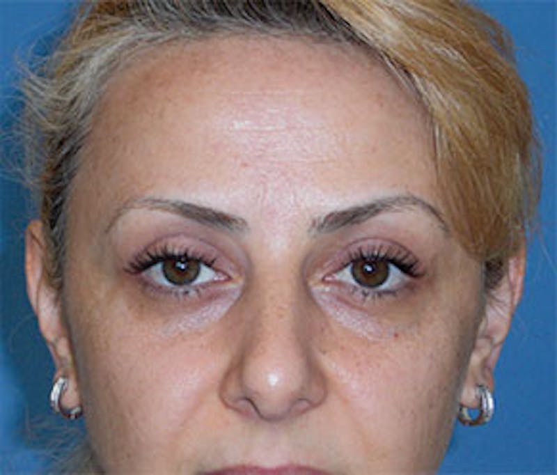 Surgical Before & After Gallery - Patient 223505 - Image 2