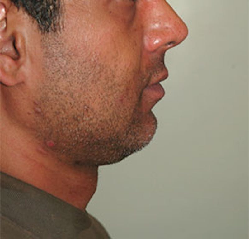Surgical Before & After Gallery - Patient 176868 - Image 1