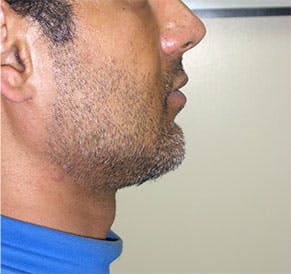 procedure