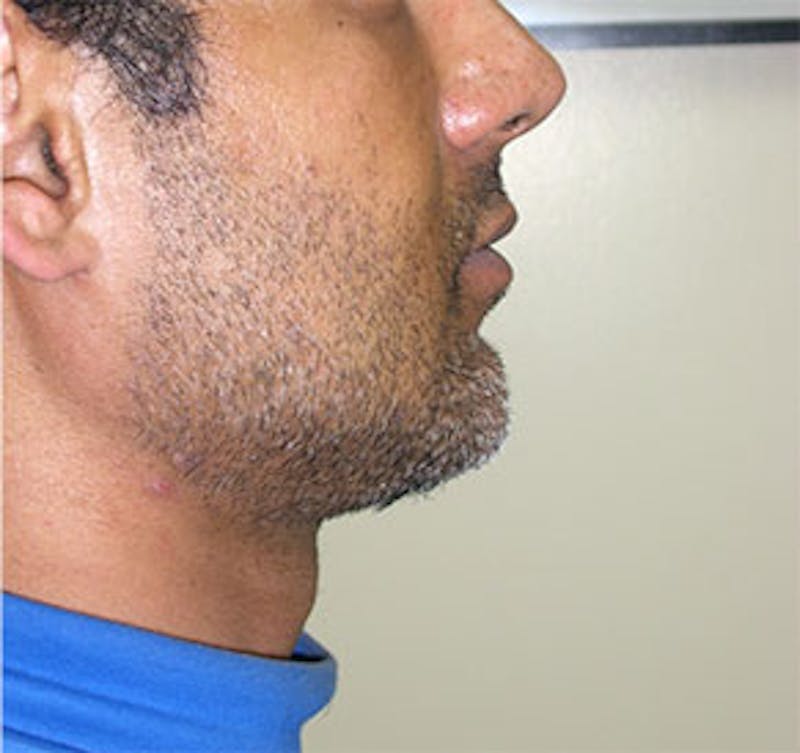 Surgical Before & After Gallery - Patient 176868 - Image 2
