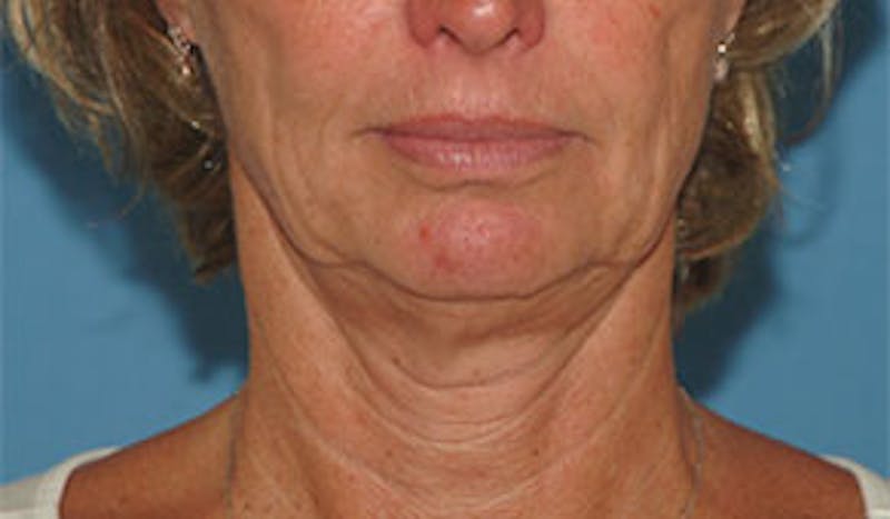 Surgical Before & After Gallery - Patient 138395 - Image 1