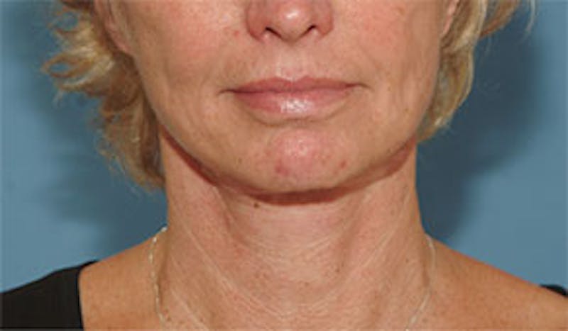 Surgical Before & After Gallery - Patient 138395 - Image 2