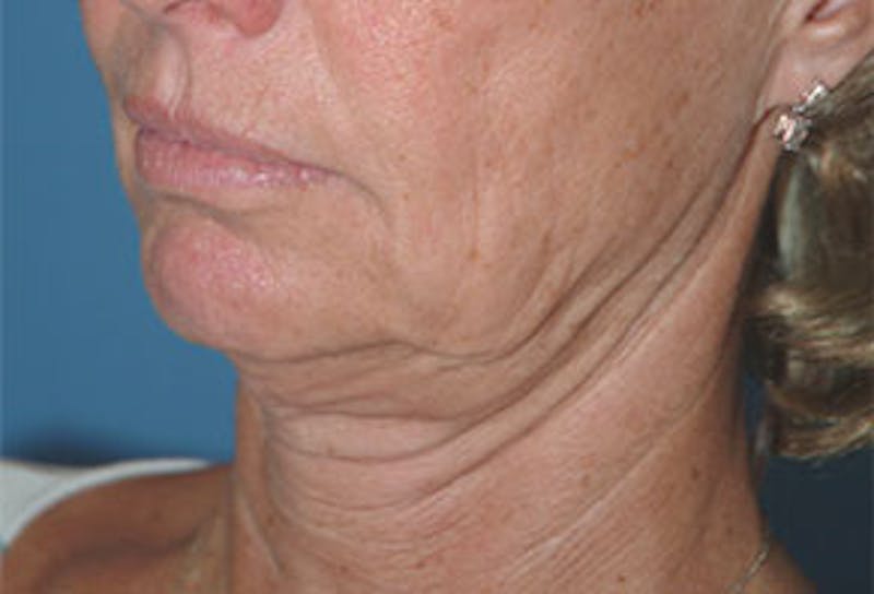 Surgical Before & After Gallery - Patient 138395 - Image 3