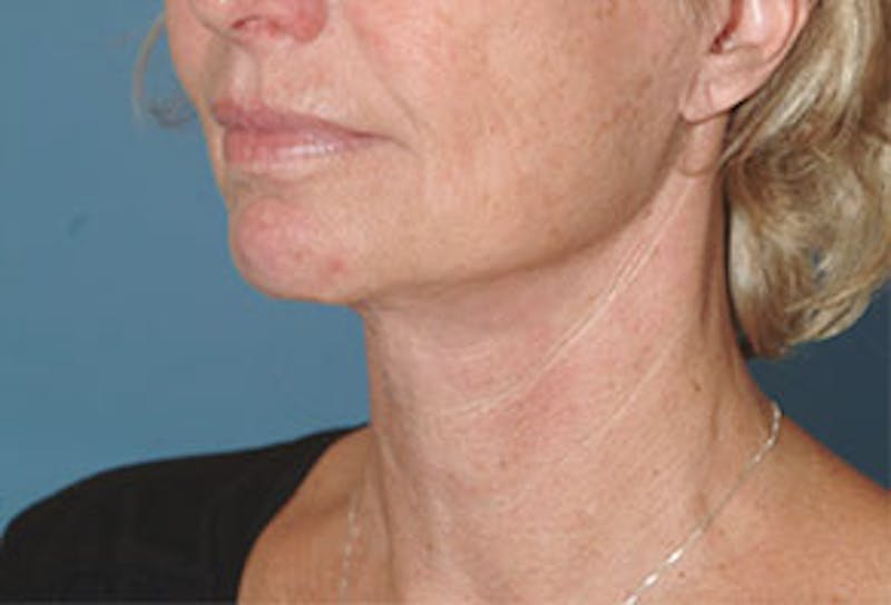 Surgical Before & After Gallery - Patient 138395 - Image 4