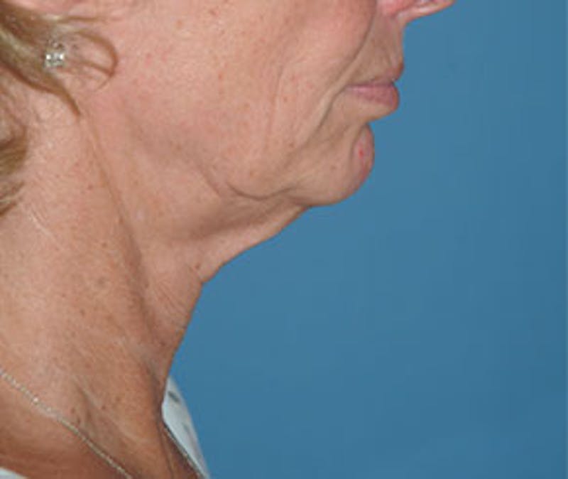 Surgical Before & After Gallery - Patient 138395 - Image 5