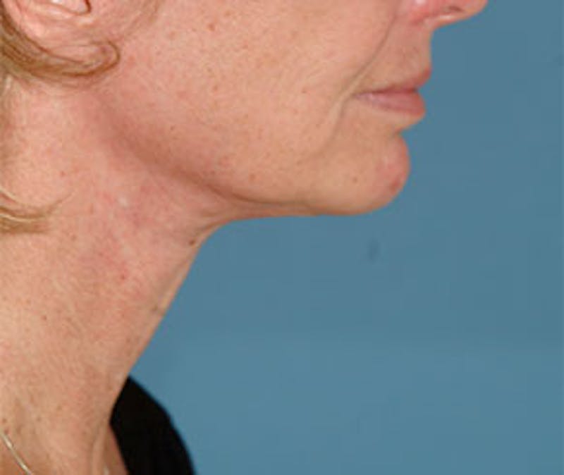 Surgical Before & After Gallery - Patient 138395 - Image 6