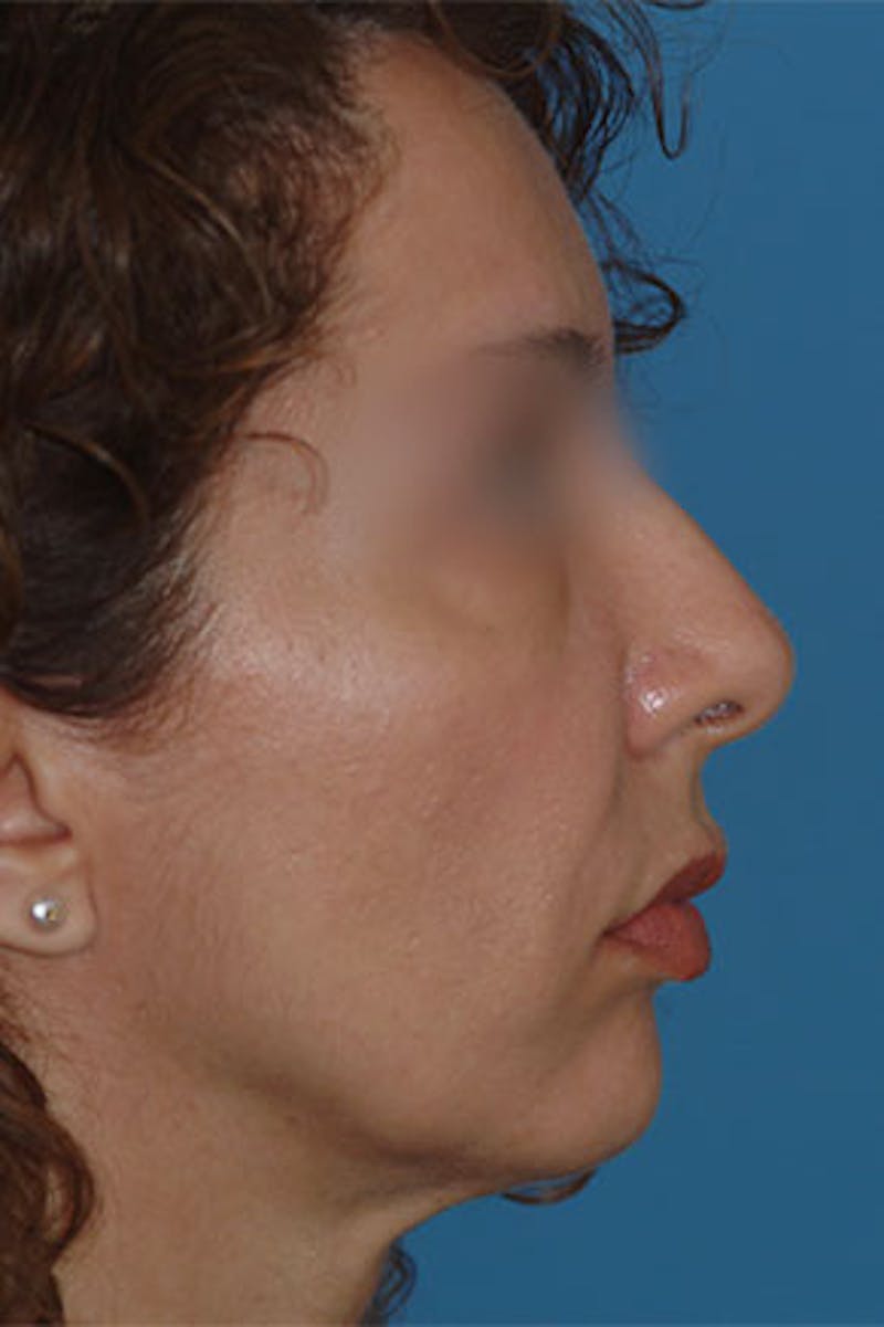 Surgical Before & After Gallery - Patient 386365 - Image 1