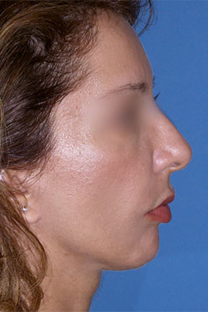 Surgical Before & After Gallery - Patient 386365 - Image 2