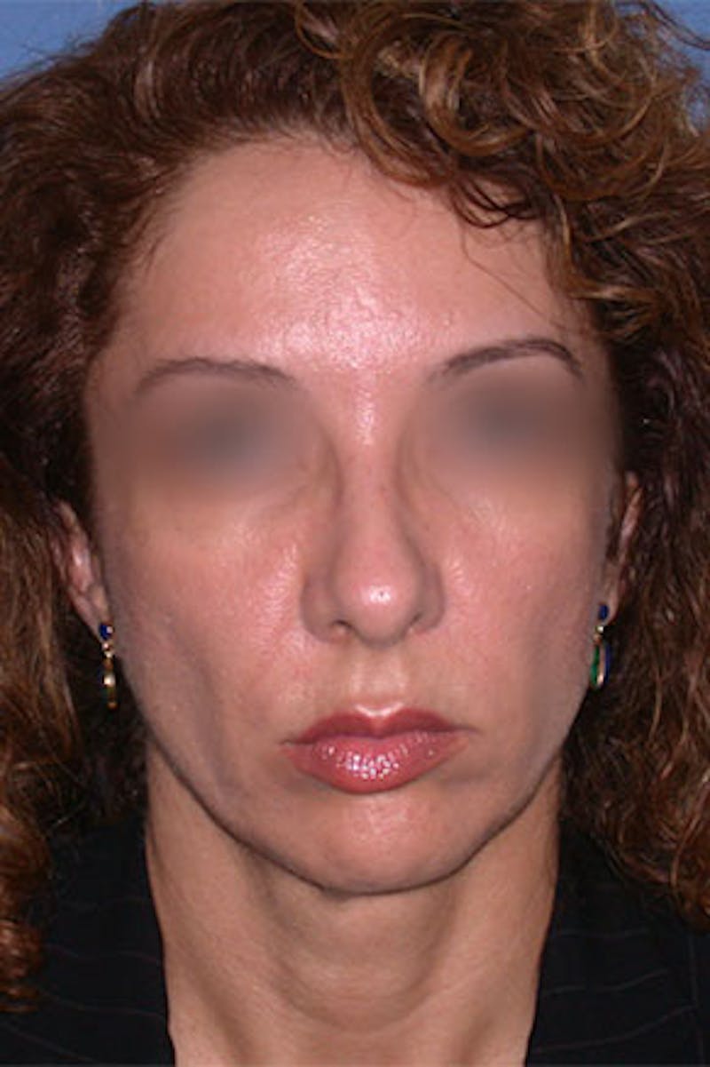 Surgical Before & After Gallery - Patient 386365 - Image 3