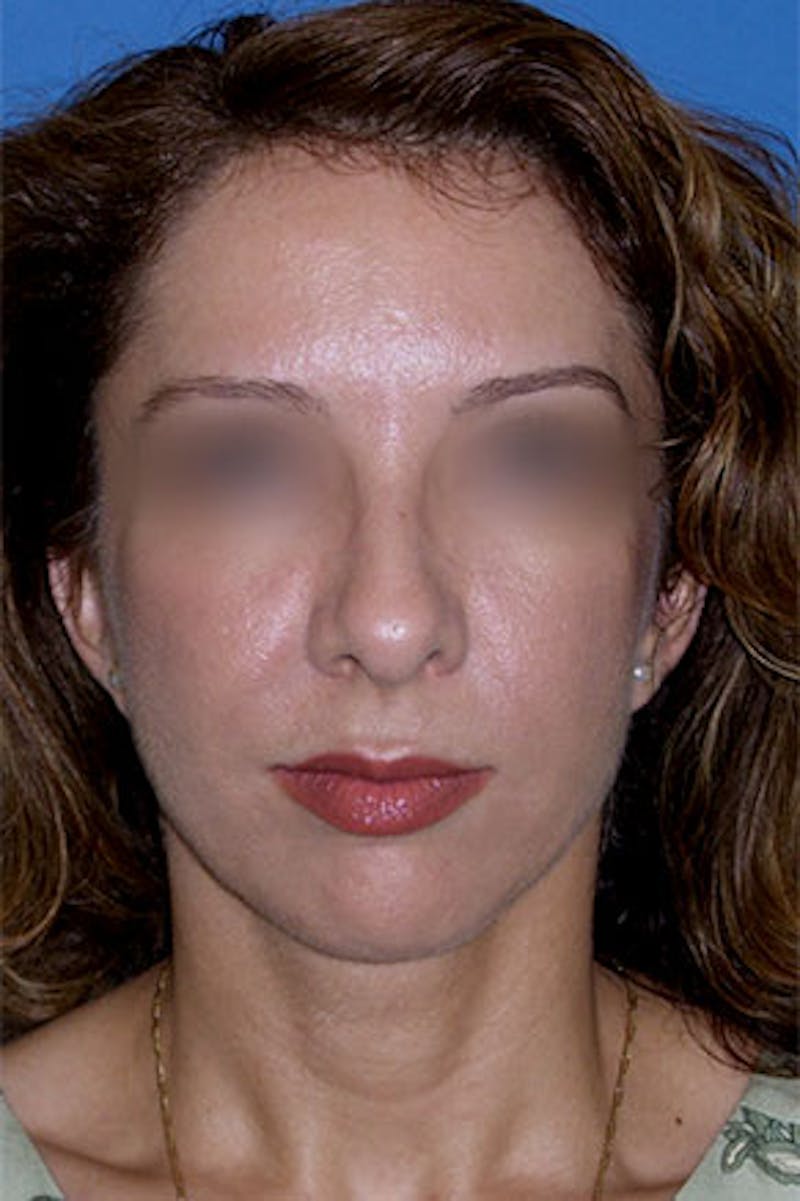 Surgical Before & After Gallery - Patient 386365 - Image 4