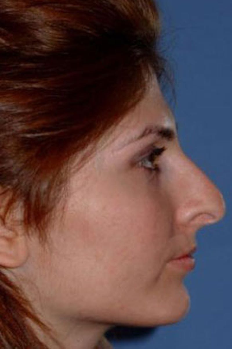 Rhinoplasty Before & After Gallery - Patient 199327 - Image 1
