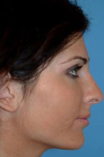 Rhinoplasty Before & After Gallery - Patient 199327 - Image 2
