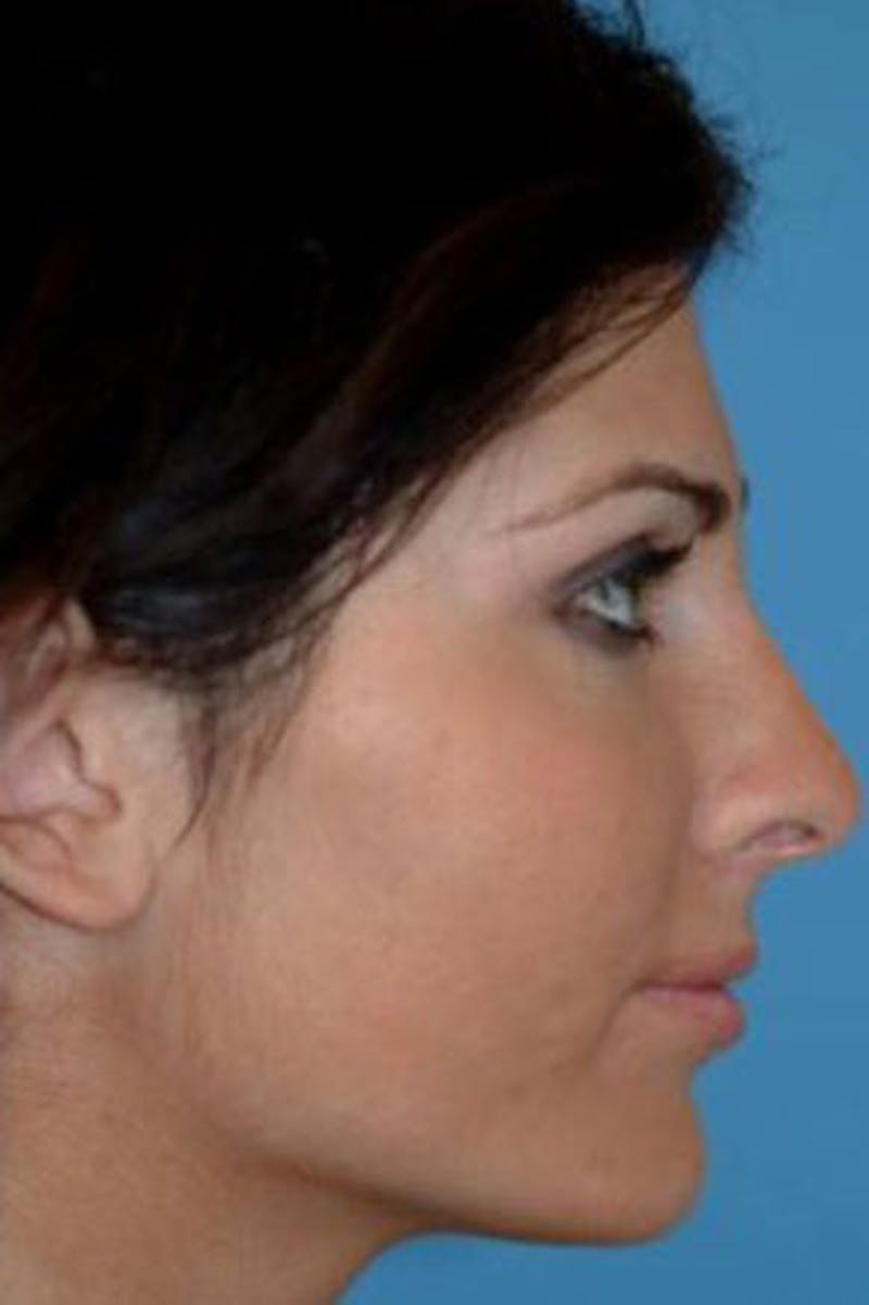 Rhinoplasty Before & After Gallery - Patient 199327 - Image 2