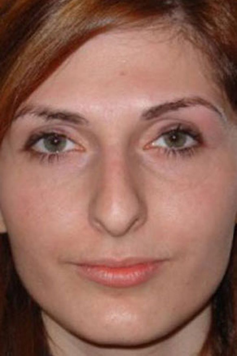 Rhinoplasty Before & After Gallery - Patient 199327 - Image 3