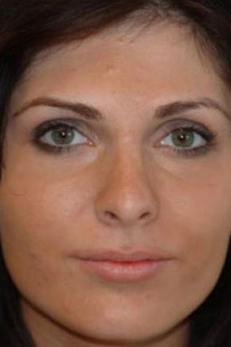 Rhinoplasty Before & After Gallery - Patient 199327 - Image 4
