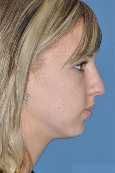 Rhinoplasty Before & After Gallery - Patient 234394 - Image 1