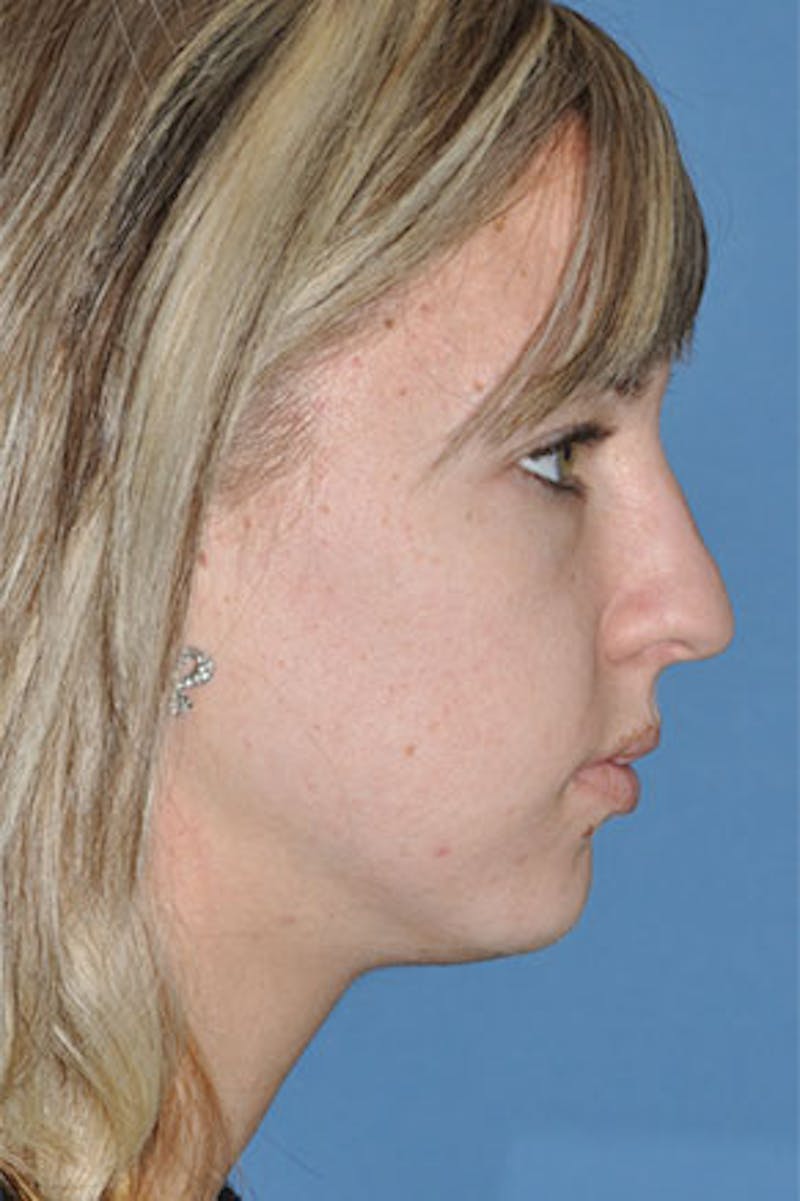 Rhinoplasty Before & After Gallery - Patient 234394 - Image 1