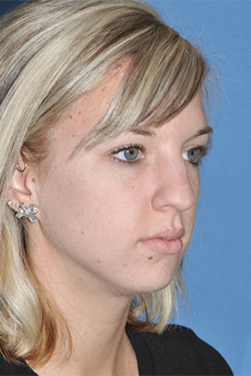 Rhinoplasty Before & After Gallery - Patient 234394 - Image 3