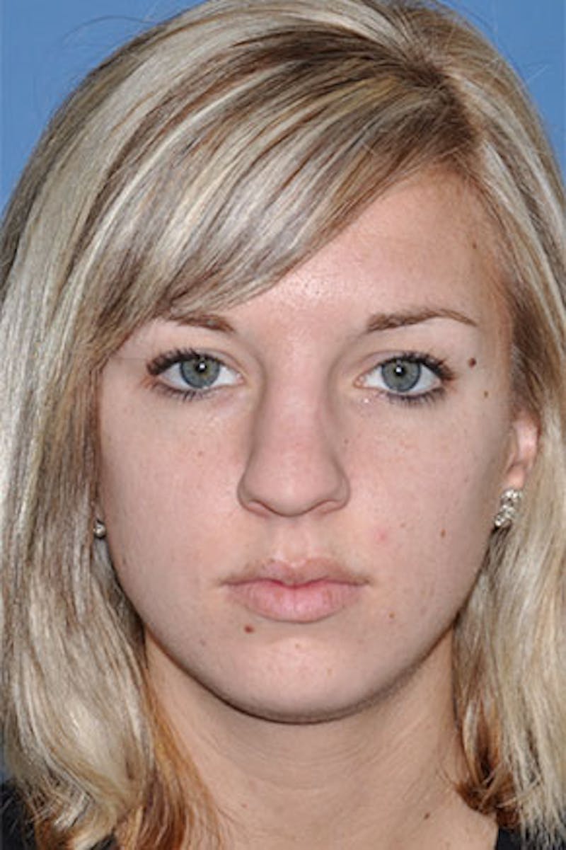 Rhinoplasty Before & After Gallery - Patient 234394 - Image 5