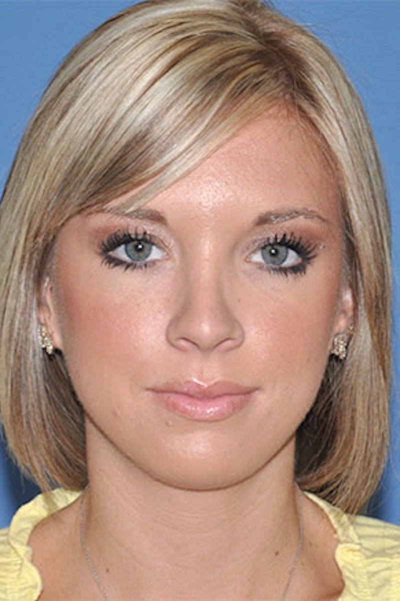 Rhinoplasty Before & After Gallery - Patient 234394 - Image 6