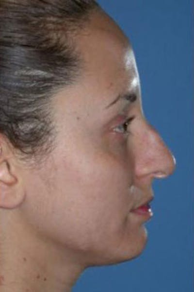 Rhinoplasty Before & After Gallery - Patient 302478 - Image 1