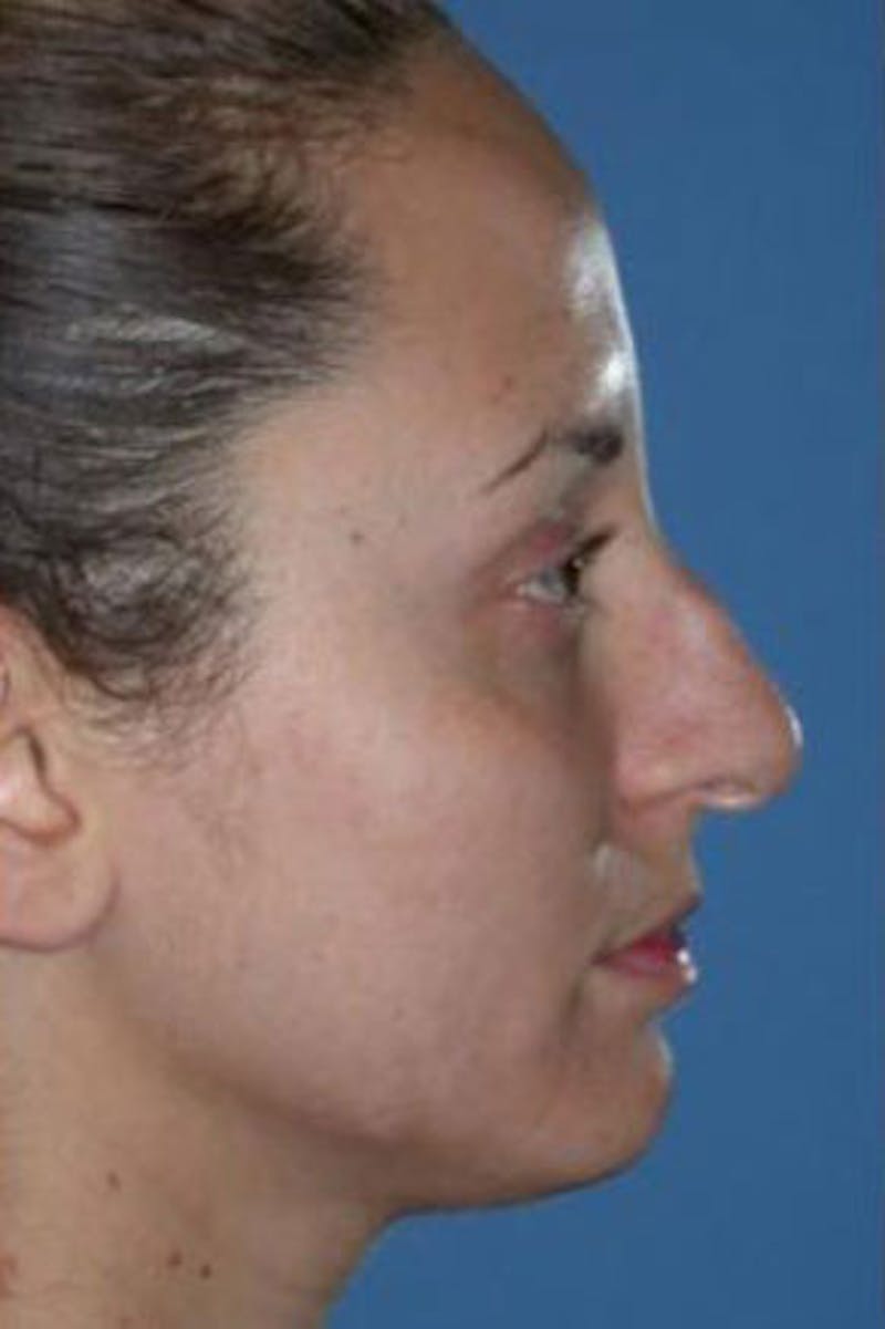 Rhinoplasty Before & After Gallery - Patient 302478 - Image 1