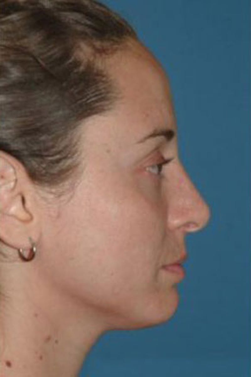 Rhinoplasty Before & After Gallery - Patient 302478 - Image 2