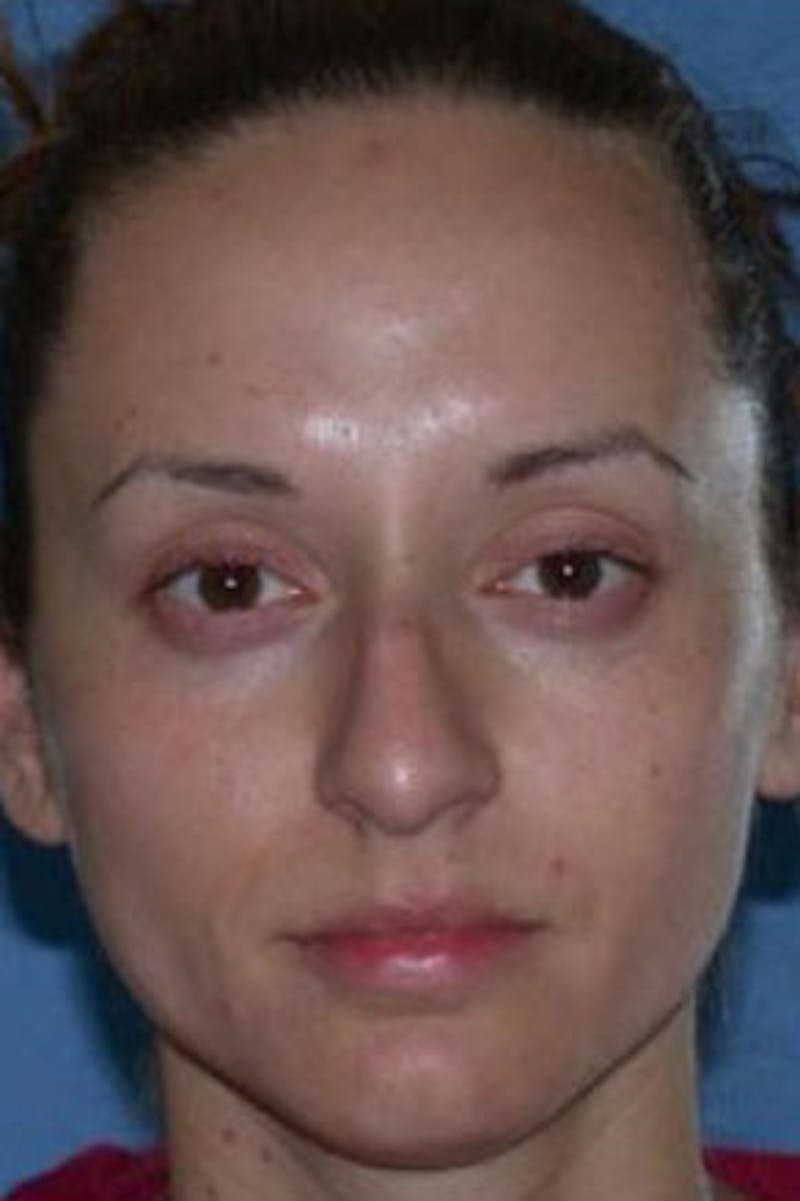 Rhinoplasty Before & After Gallery - Patient 302478 - Image 3