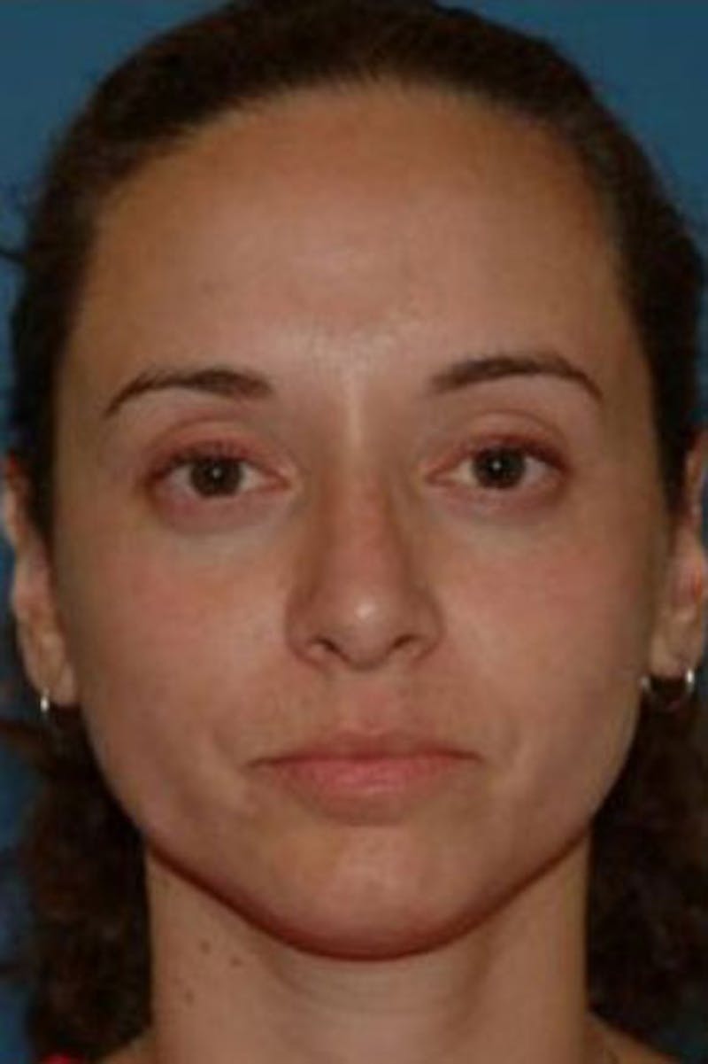 Rhinoplasty Before & After Gallery - Patient 302478 - Image 4