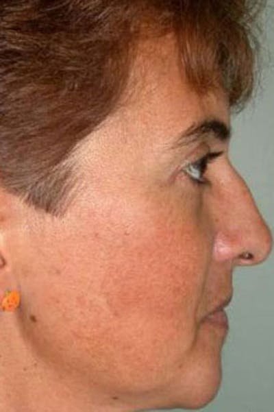 Rhinoplasty Before & After Gallery - Patient 298821 - Image 1