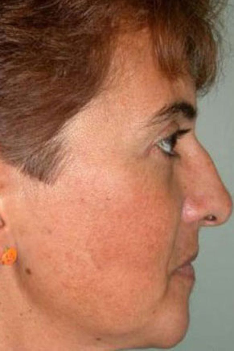 Rhinoplasty Before & After Gallery - Patient 298821 - Image 1
