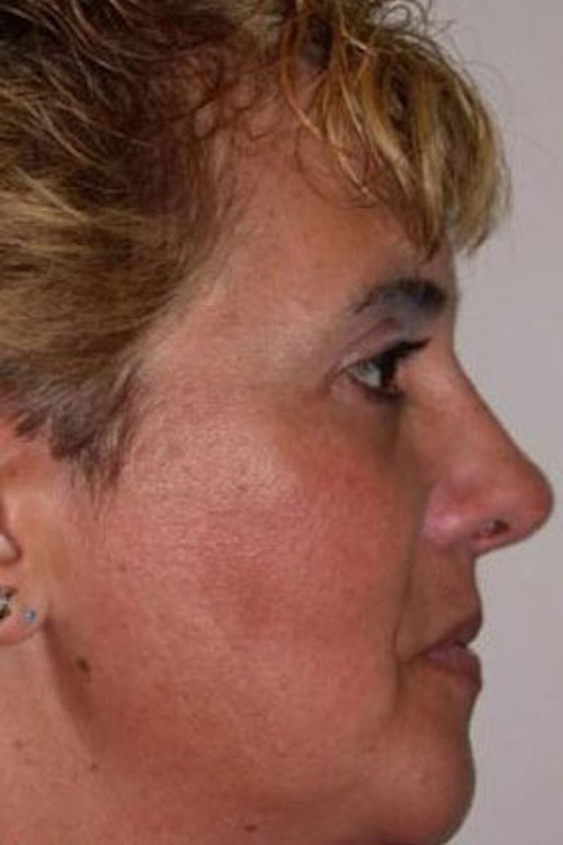 Rhinoplasty Before & After Gallery - Patient 298821 - Image 2