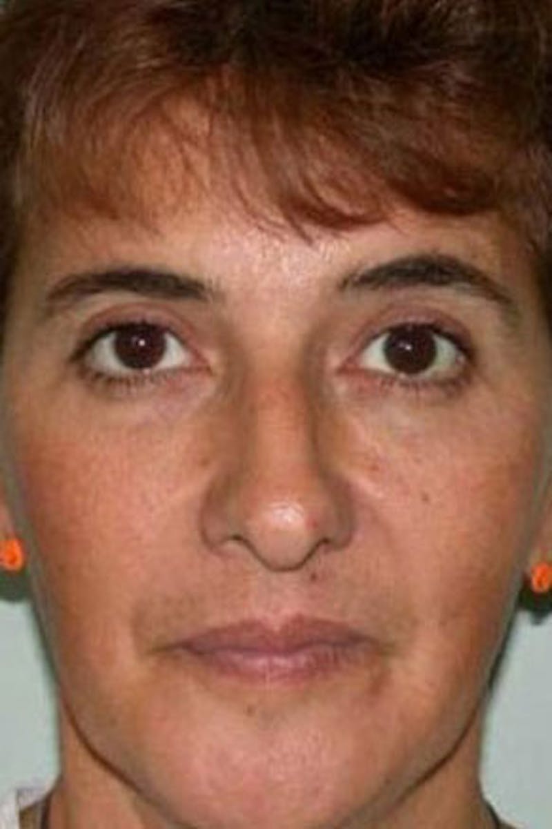 Rhinoplasty Before & After Gallery - Patient 298821 - Image 3