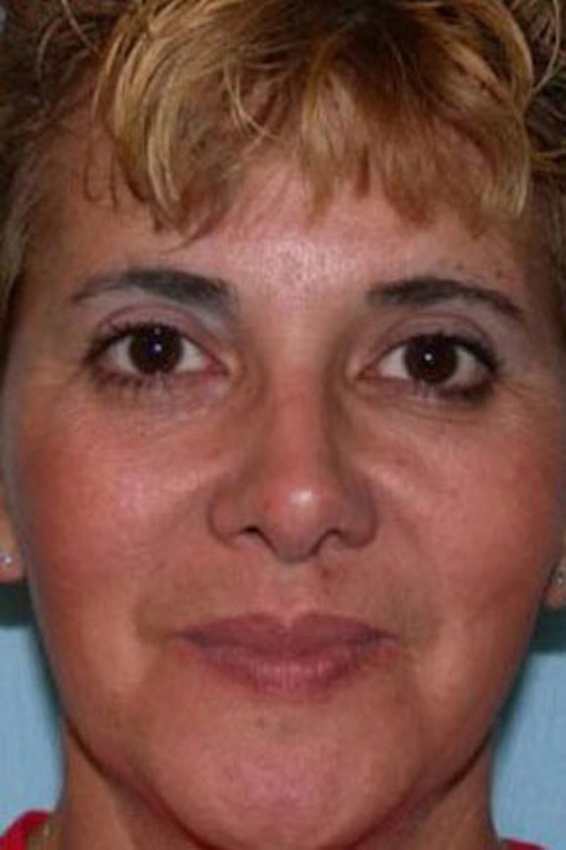 Rhinoplasty Before & After Gallery - Patient 298821 - Image 4
