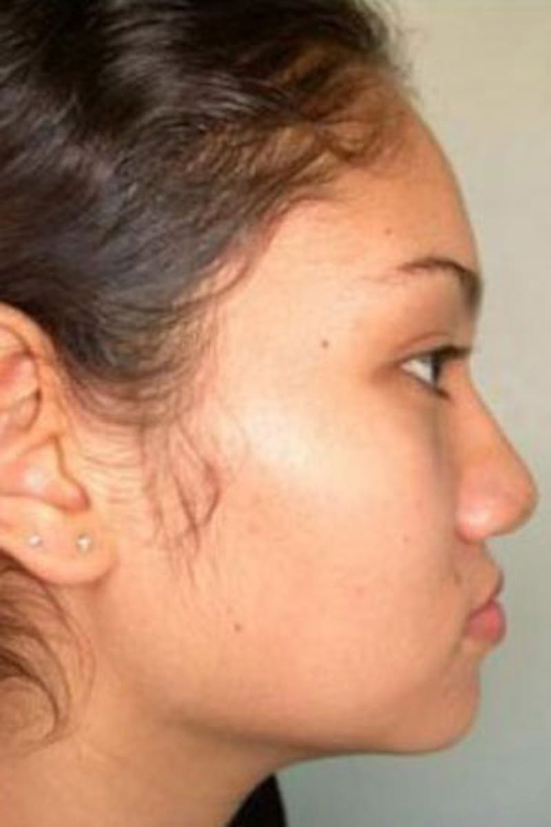 Rhinoplasty Before & After Gallery - Patient 548230 - Image 1