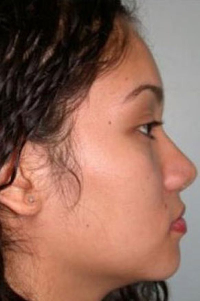 Rhinoplasty Before & After Gallery - Patient 548230 - Image 2