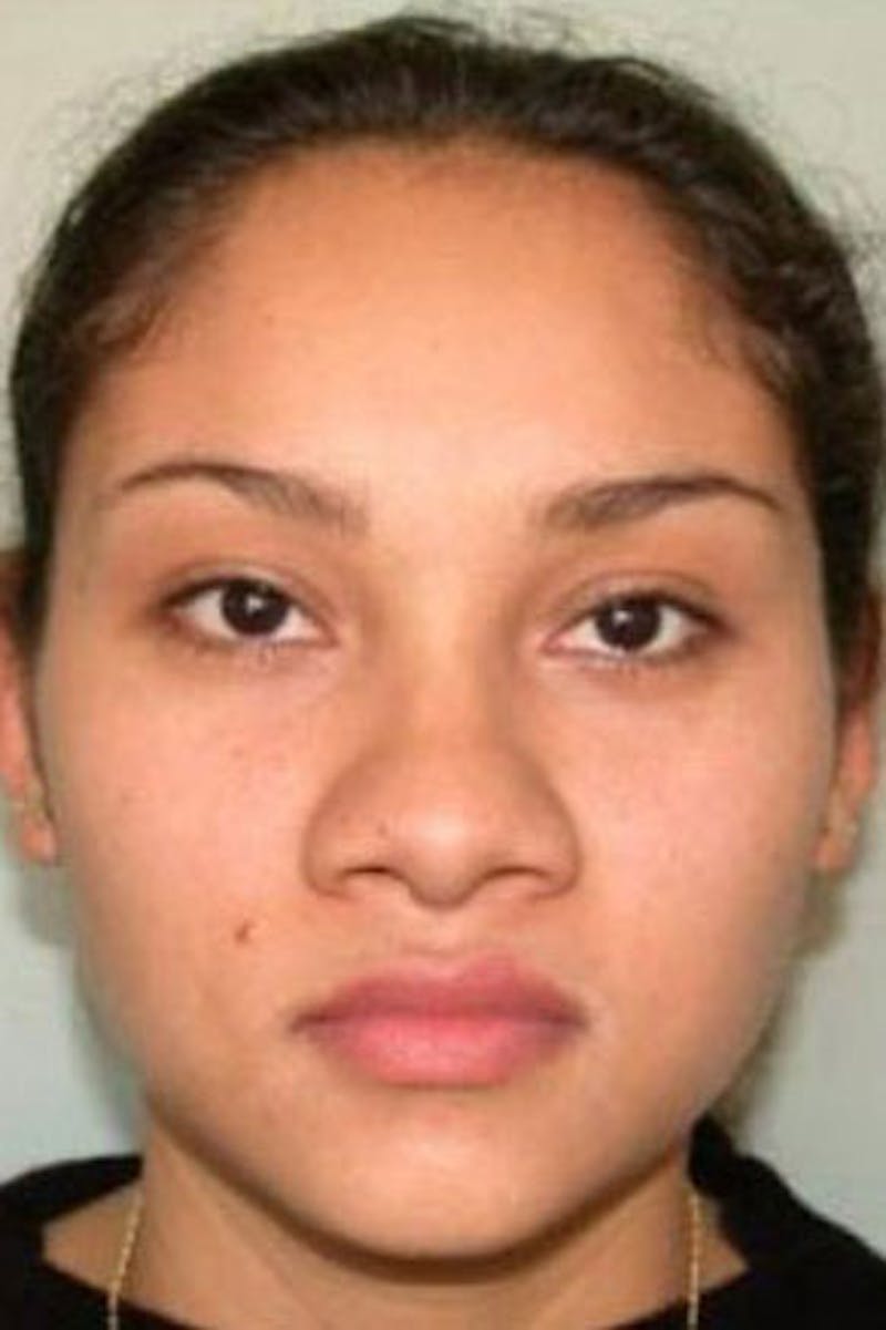 Rhinoplasty Before & After Gallery - Patient 548230 - Image 3