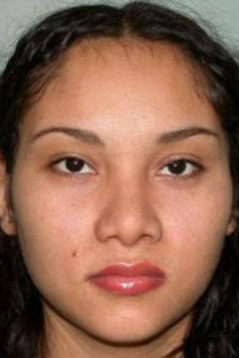 Rhinoplasty Before & After Gallery - Patient 548230 - Image 4