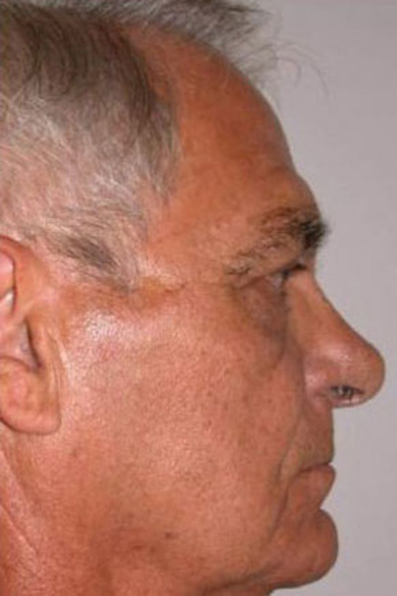 Rhinoplasty Before & After Gallery - Patient 349852 - Image 1