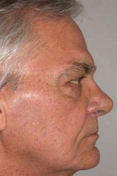 Rhinoplasty Before & After Gallery - Patient 349852 - Image 2