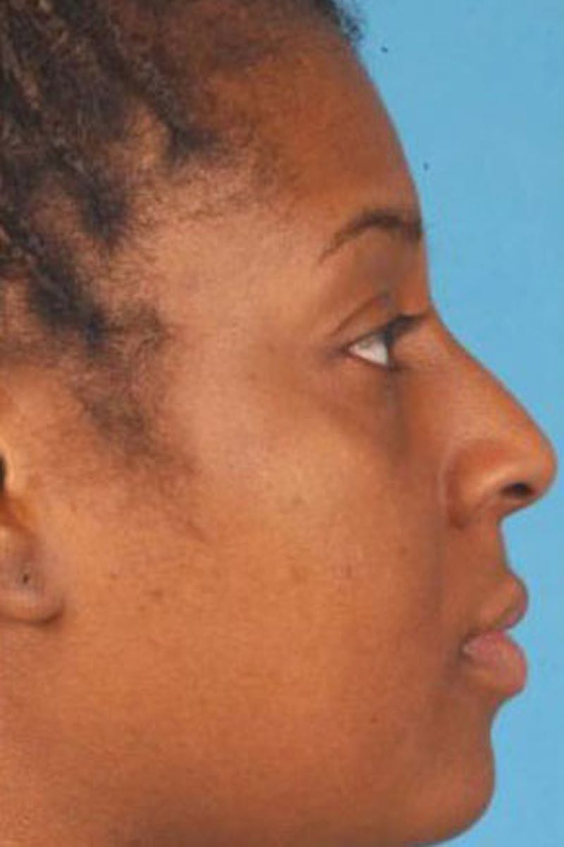 Rhinoplasty Before & After Gallery - Patient 476056 - Image 1
