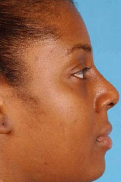 Rhinoplasty Before & After Gallery - Patient 476056 - Image 2