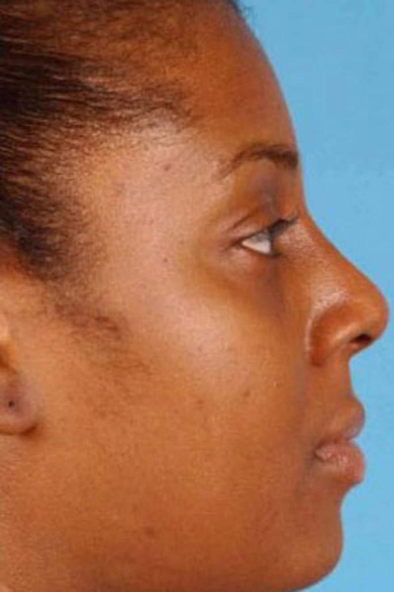 Rhinoplasty Before & After Gallery - Patient 476056 - Image 2