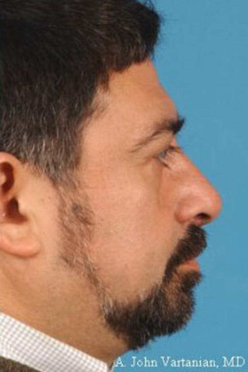 Rhinoplasty Before & After Gallery - Patient 401753 - Image 1