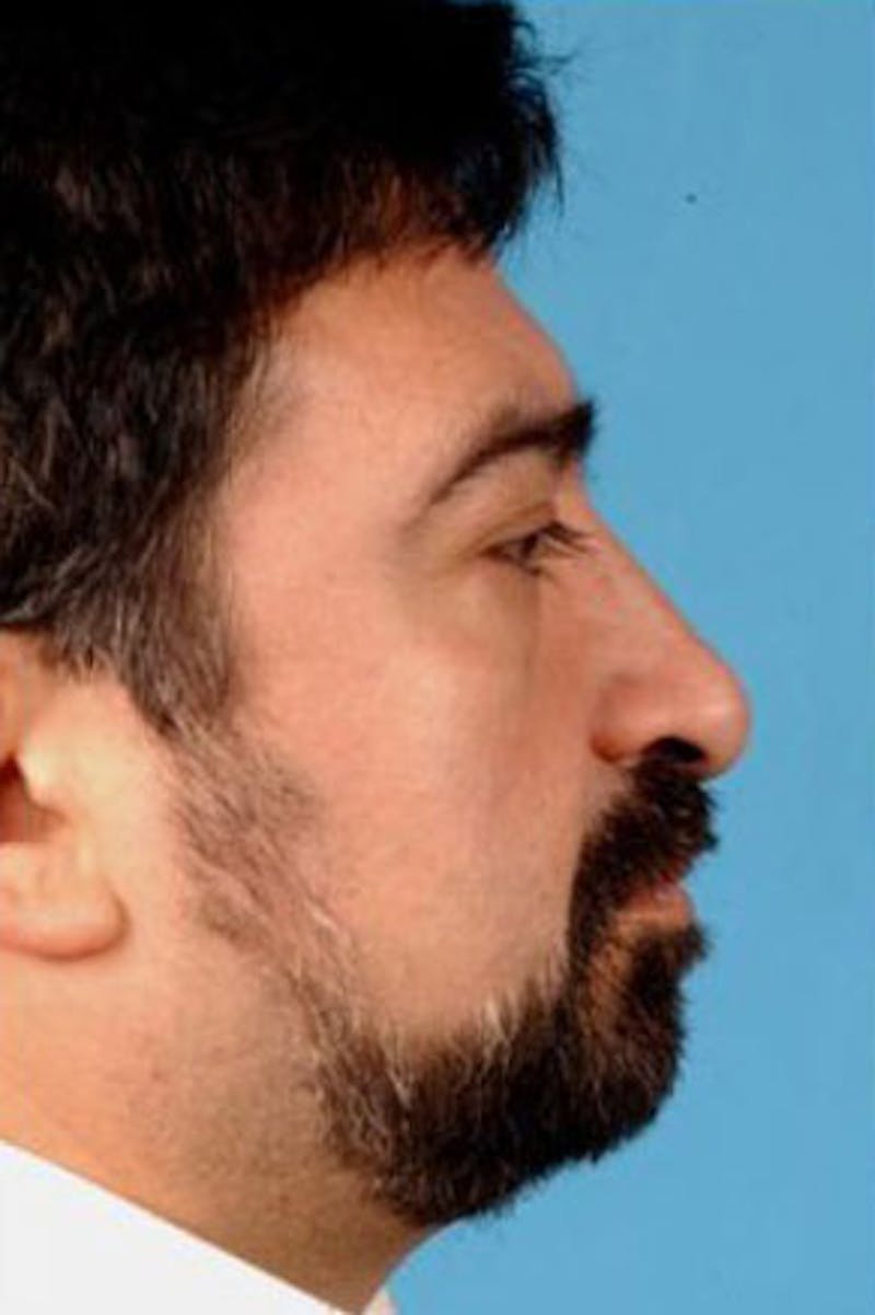 Rhinoplasty Before & After Gallery - Patient 401753 - Image 2