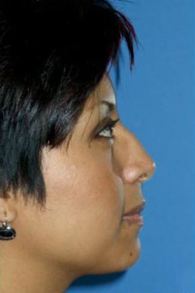 Rhinoplasty Before & After Gallery - Patient 126989 - Image 1
