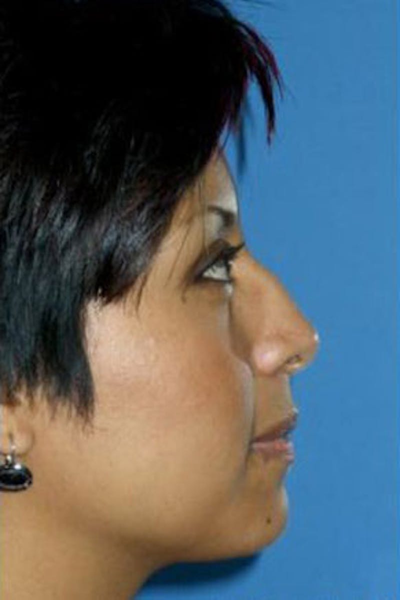 Rhinoplasty Before & After Gallery - Patient 126989 - Image 1