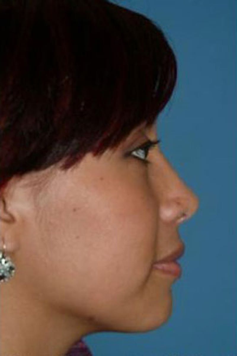 Rhinoplasty Before & After Gallery - Patient 126989 - Image 2