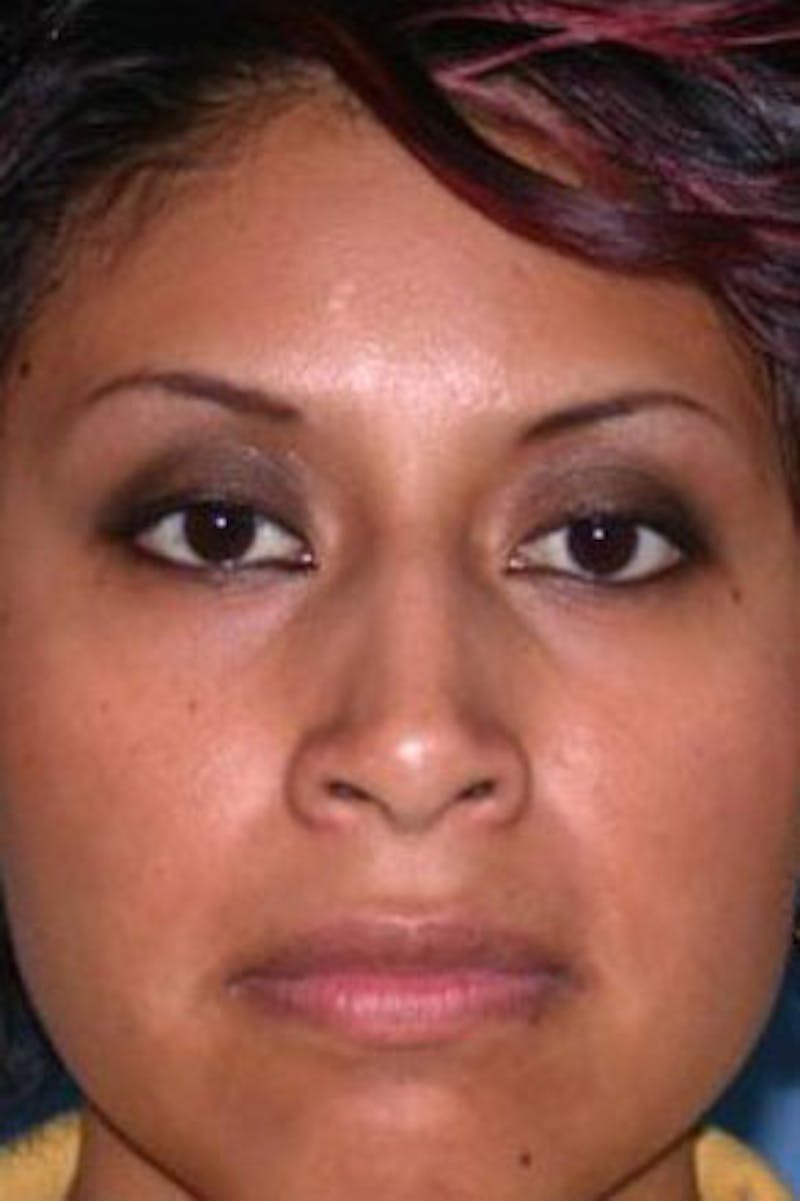 Rhinoplasty Before & After Gallery - Patient 126989 - Image 3