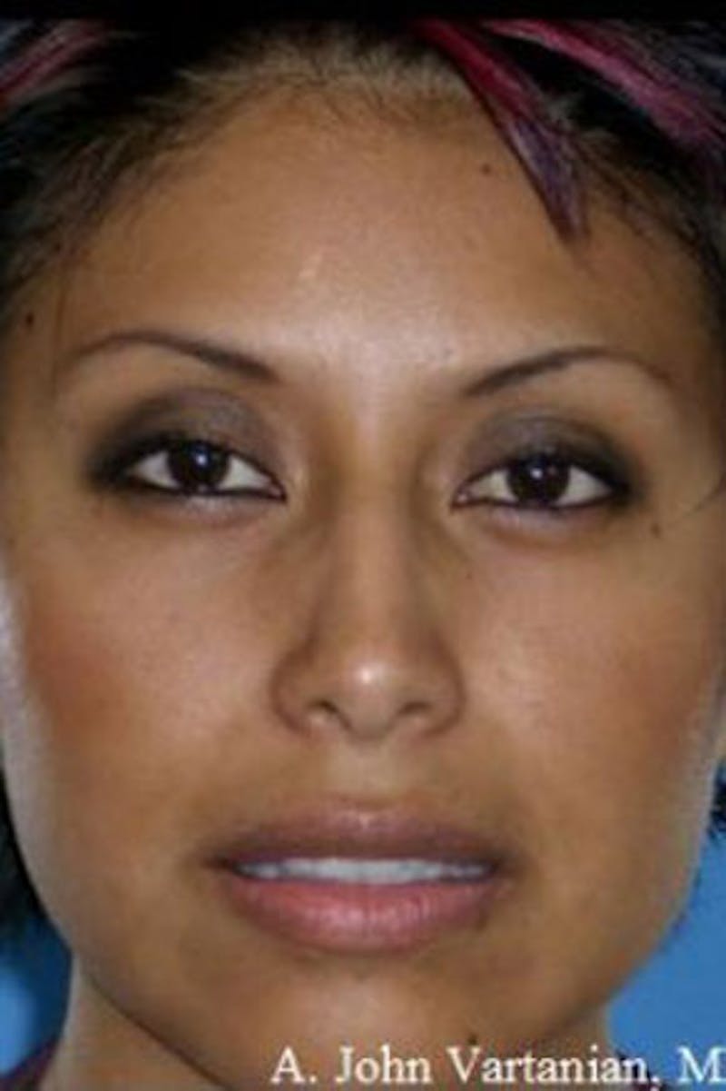 Rhinoplasty Before & After Gallery - Patient 126989 - Image 4